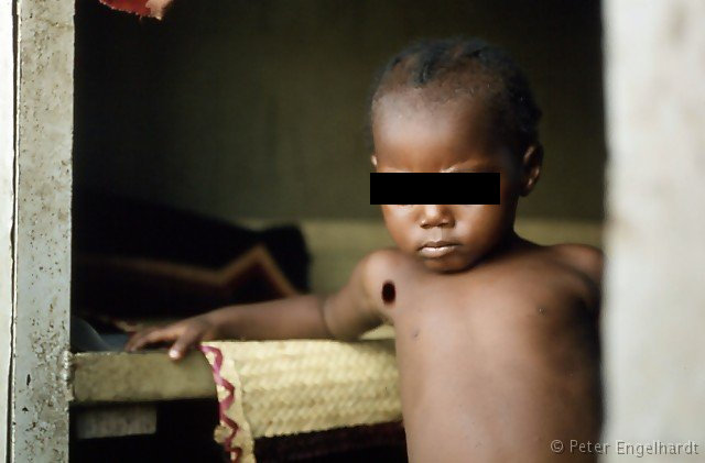 Foto eines an Hautkrebs erkrankten Kindes, welches mit Mutter und Bruder auf den Flußschiff Vakaga zur Operation in die kongolesische Hauptstadt Brazzaville fuhr.